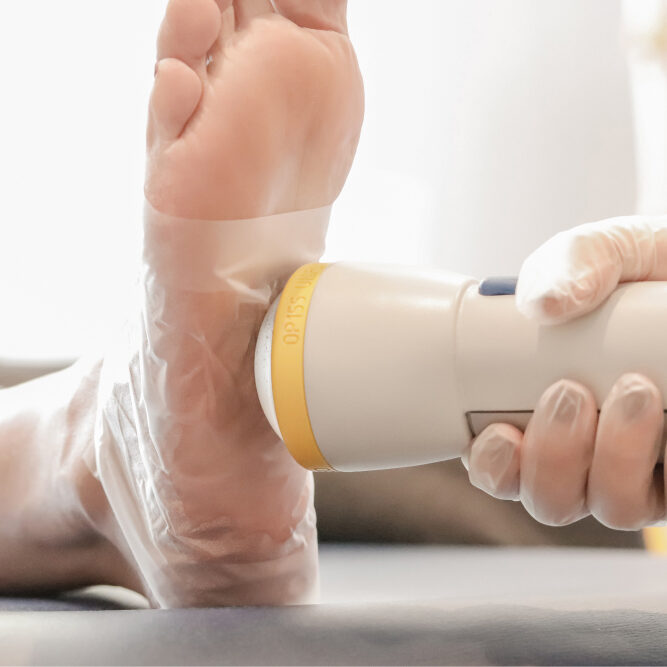 foot-treatment SoftWave Foot Treatment